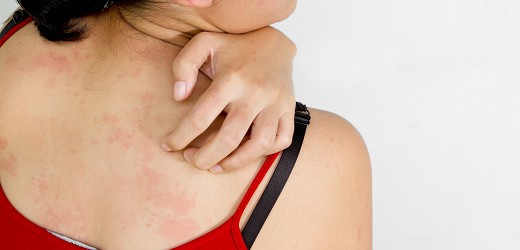 ‚Schweißallergie‘ – was nun?
