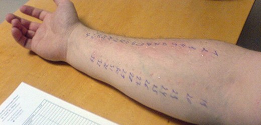 Allergie – was ist das?